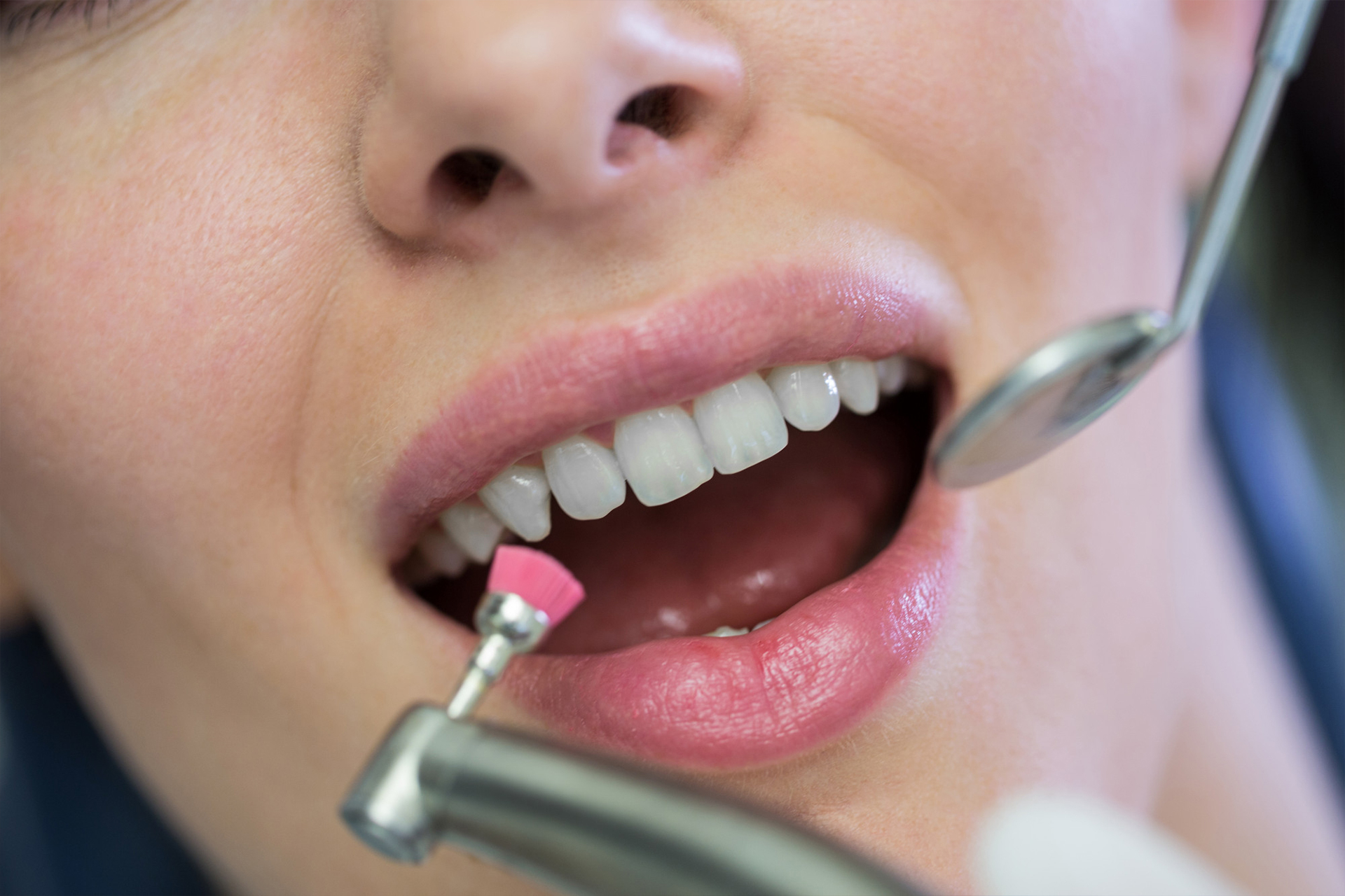 Fillings