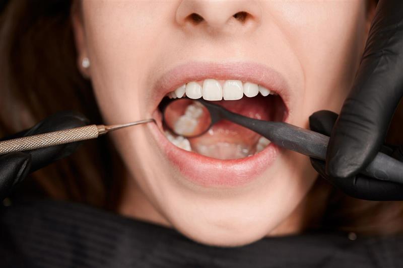Tooth Extractions